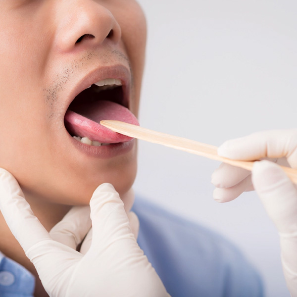 viêm lưỡi bản đồ