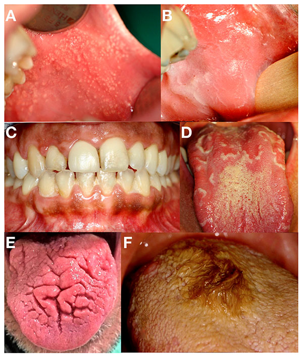 viêm lưỡi bản đồ