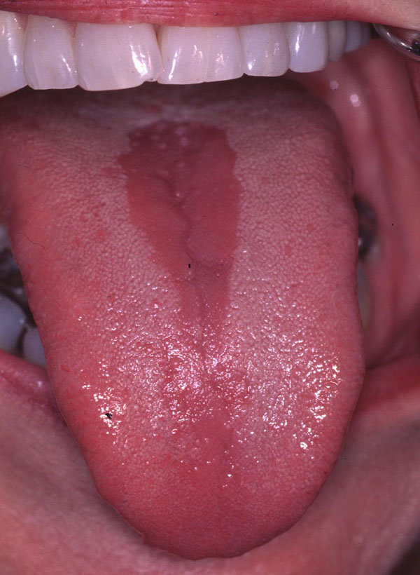viêm lưỡi bản đồ