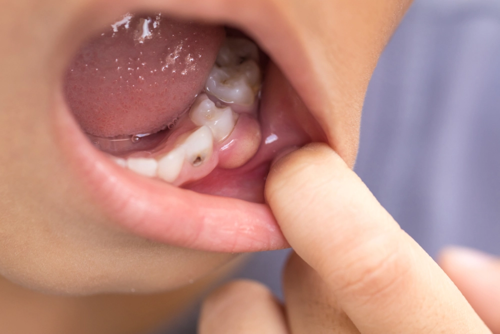 triệu chứng áp xe răng, dấu hiệu áp xe răng, áp xe răng bị sưng mặt, áp xe răng đau nhức, áp xe răng chảy mủ, áp xe răng sốt, áp xe răng hôi miệng, áp xe răng đau tai, áp xe răng sưng nướu, áp xe răng có nguy hiểm không