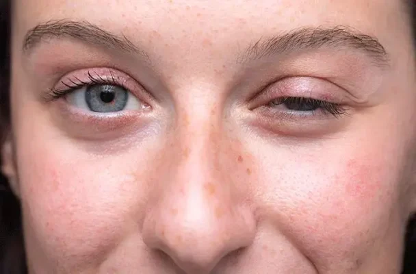bệnh nhược cơ tổng quát, nhược cơ toàn thân, generalized myasthenia gravis, bệnh nhược cơ là gì, bệnh nhược cơ tự miễn